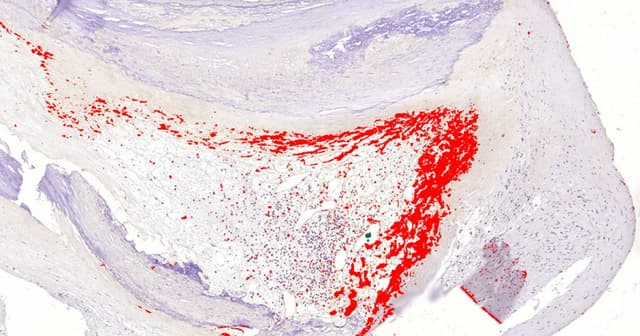 Myocardial infarction may be an infectious disease - Featured Image